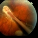 Familial Exudative Vitreoretinopathy Familial Exudative Vitreoretinopathy